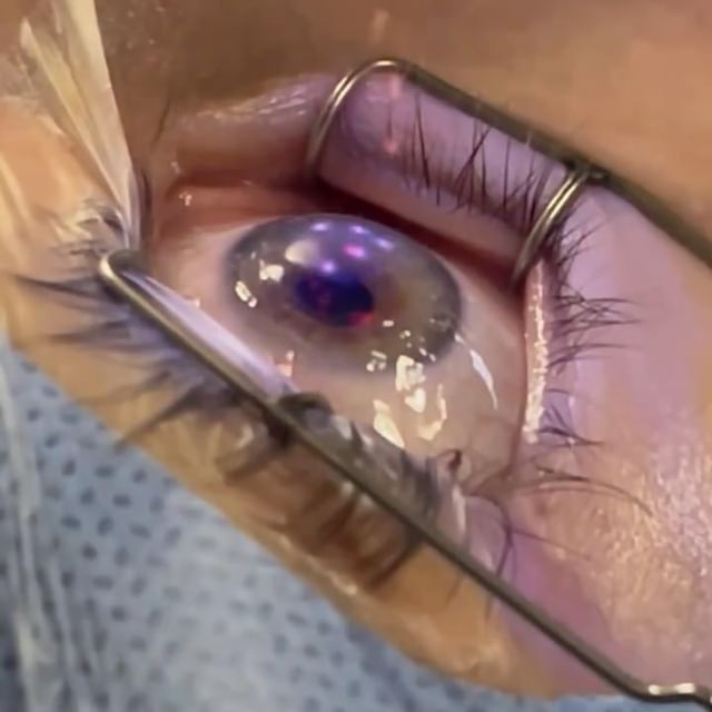 Göz Bozukluklarında Modern Tedavi Yöntemleri: Lasik ve Excimer Laser